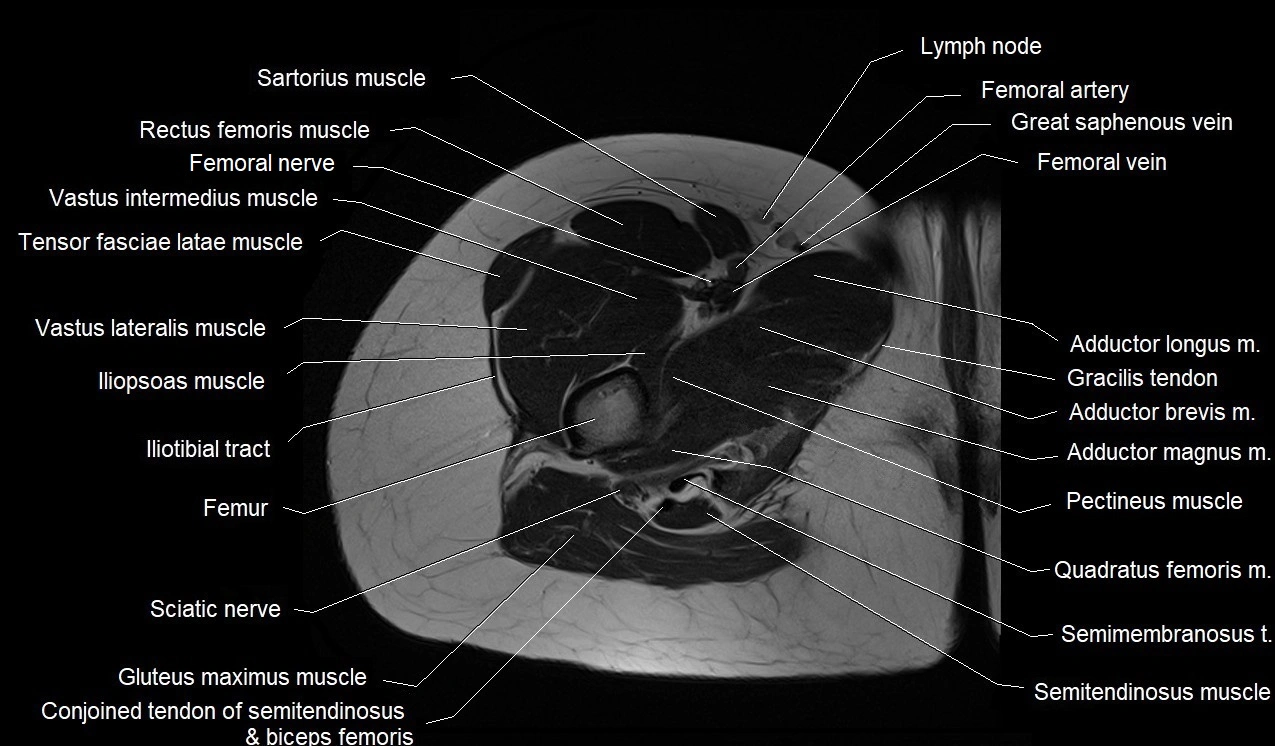 MRI thigh cross sectional anatomy image 15.webp